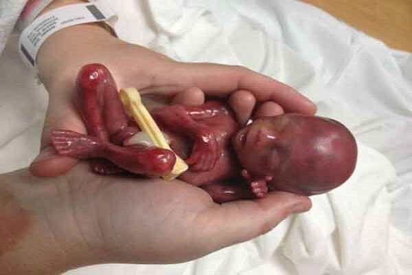 سقط جنین؛ از «صنعت پولهای سیاه» تا عوارض جبرانناپذیر جسمی و روانی سقط جنین؛ از «صنعت پولهای سیاه» تا عوارض جبرانناپذیر جسمی و روانی