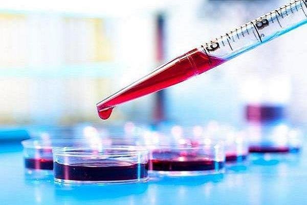 تشخیص کبد چرب الکلی با آزمایش خون تشخیص کبد چرب الکلی با آزمایش خون