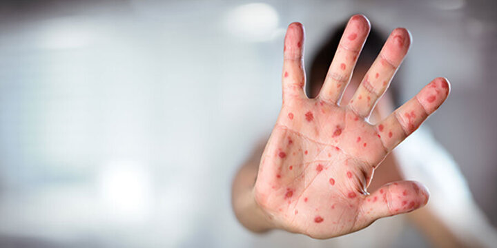 موج سرخک در بنگلادش جان ۵۰۰ کودک را گرفت موج سرخک در بنگلادش جان ۵۰۰ کودک را گرفت